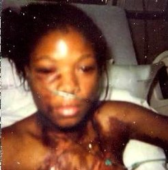 Kimberly Morton after her attack